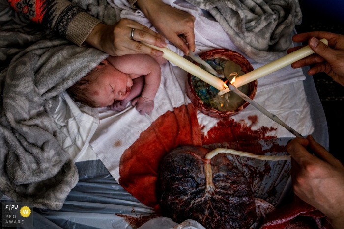 Moment driven Zwolle birth photojournalism image of a cord burning Moment driven Zwolle birth photojournalism image of a cord burning